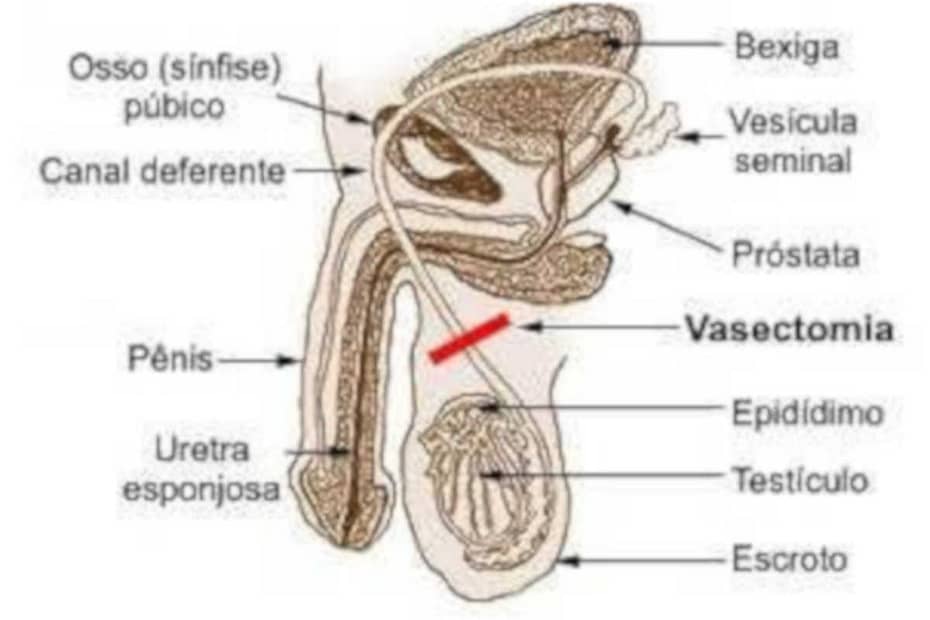 Mitos sobre vasectomia - destacada