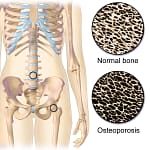 Osteoporose - Destacada