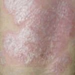 Psoríase - doença de pele não contagiosa - destacada